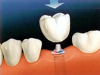 Implant dentaire